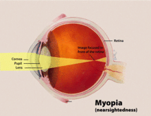 220px-Myopia